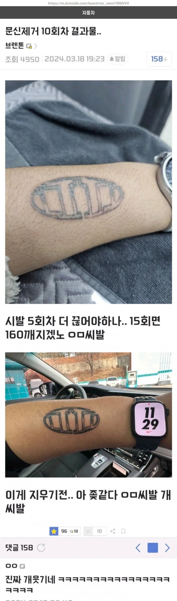 문신제거 10회차인 차갤러..