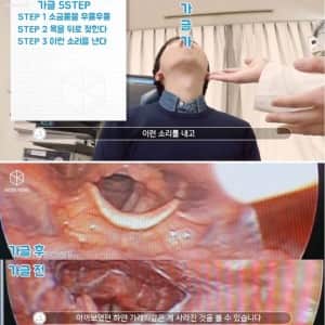 양치하고 가글 반드시 해야 되는 이유