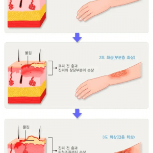 화상이 얼마나 심각한 부상인지 알아보자