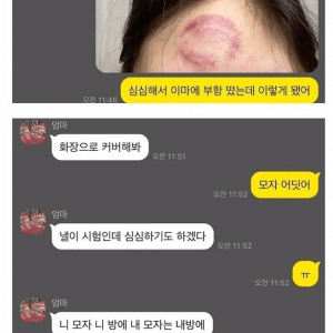 심심해서 이마에 부항 뜬 누나