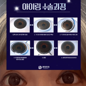 (약혐) 인스타에서조차 반응 박살난 수술