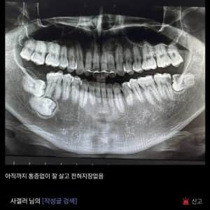 싱글벙글 익스트림 사랑니갤
