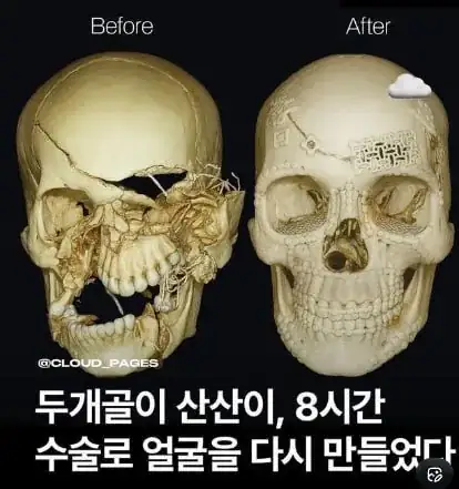 산산조각난 두개골  8시간 수술 