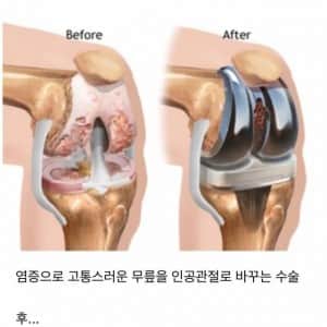 러닝 과도하게 하면 안되는 이유