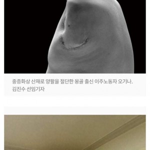 50만원 때문에 양팔을 잃은 외국인 노동자